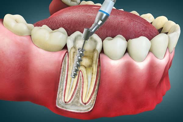 Root Canal in Tempe, AZ