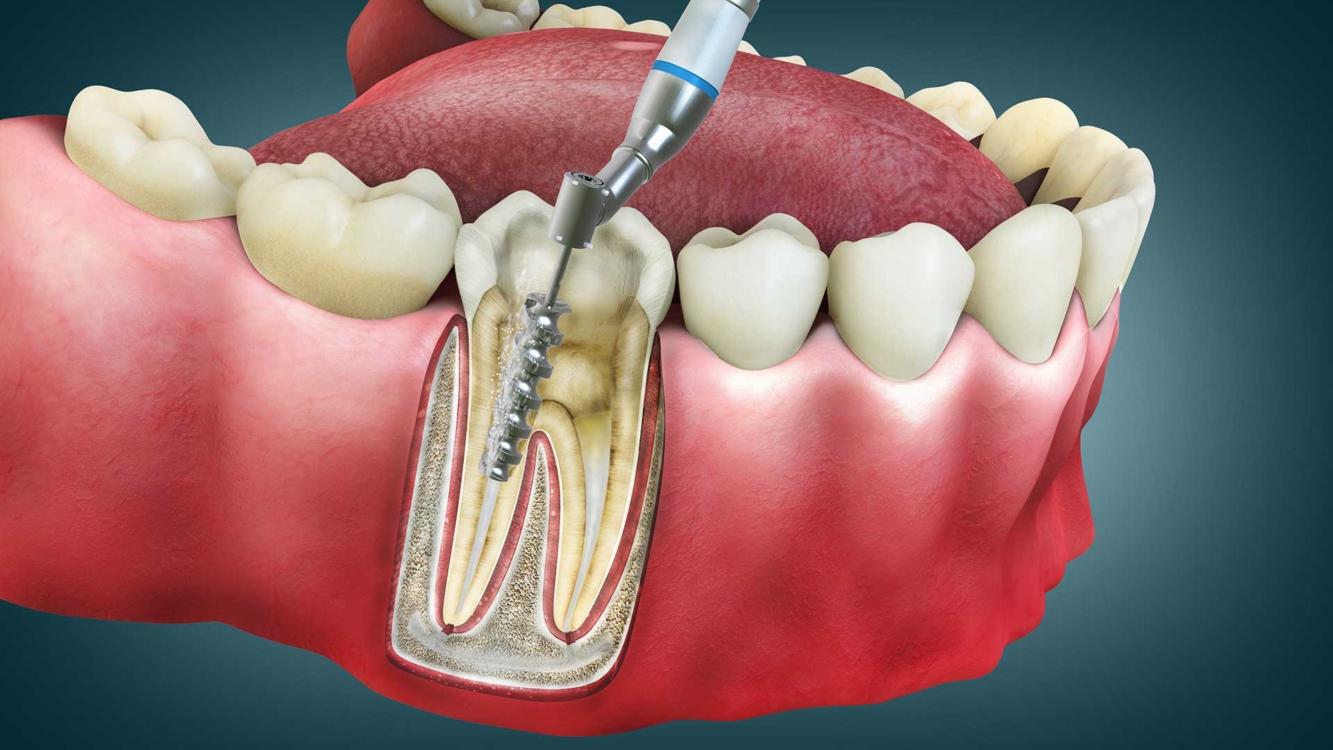 Root Canal Treatment in Hayward, California