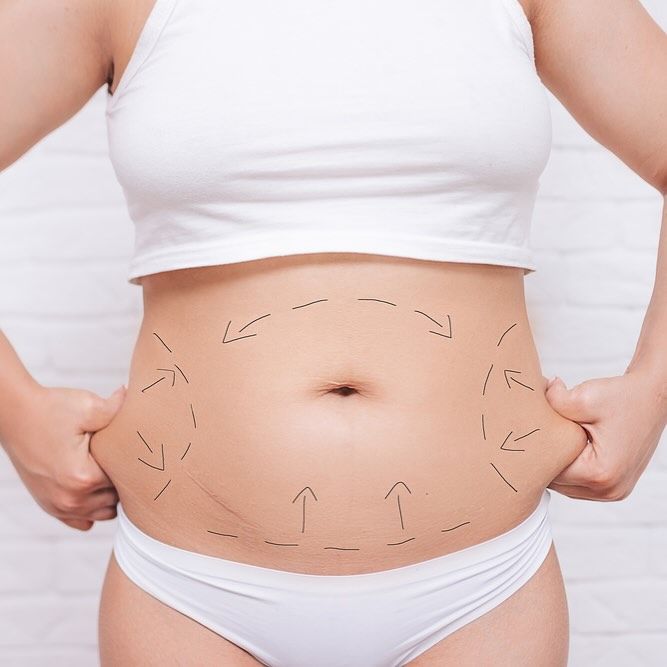 liposuction in islamabad