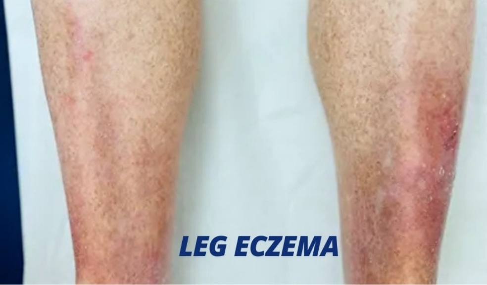Eczema on the legs