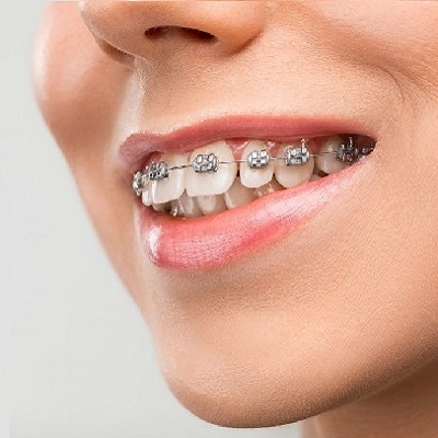 teeth braces in islamabad