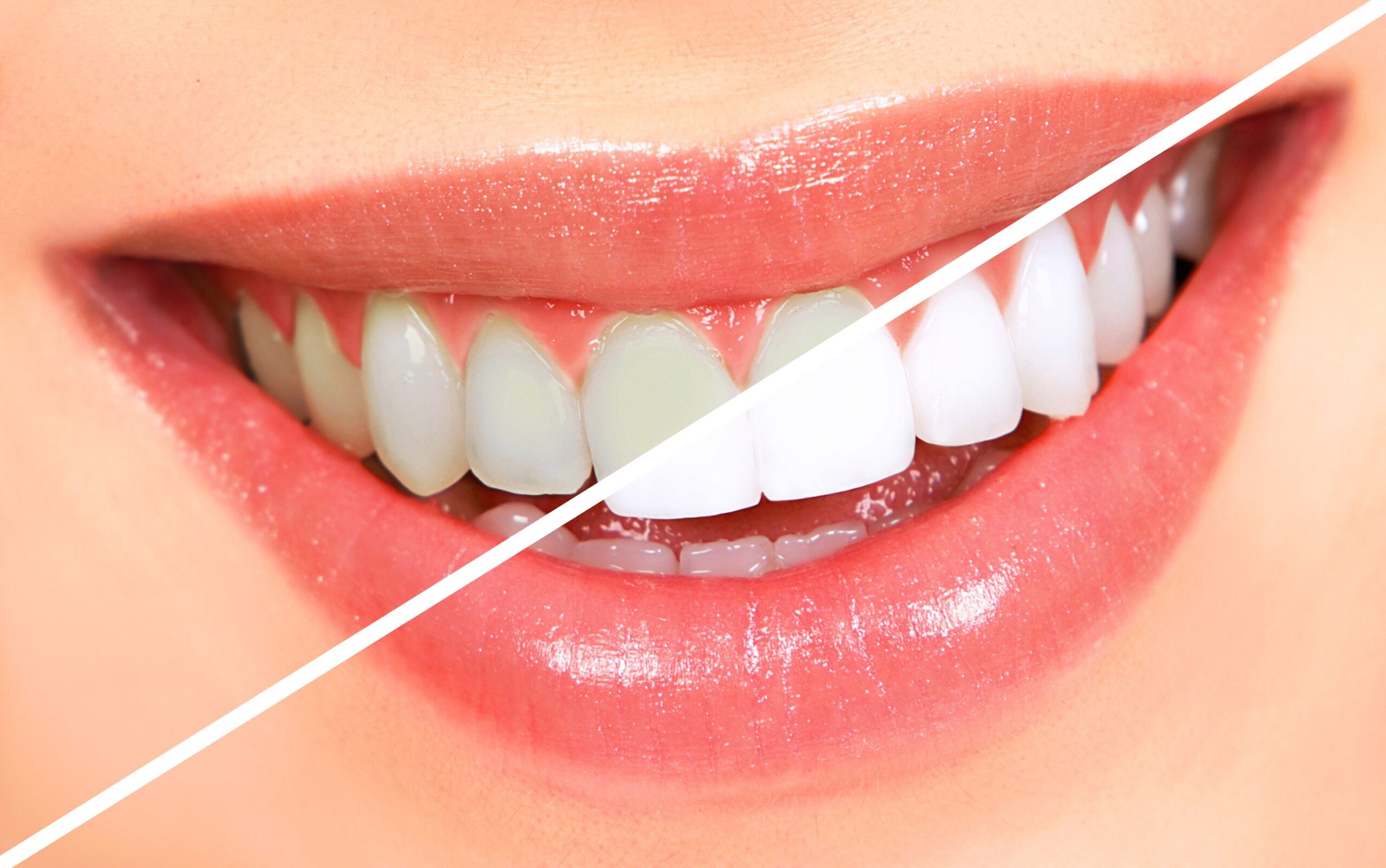 Teeth Whitening in Kingman, AZ