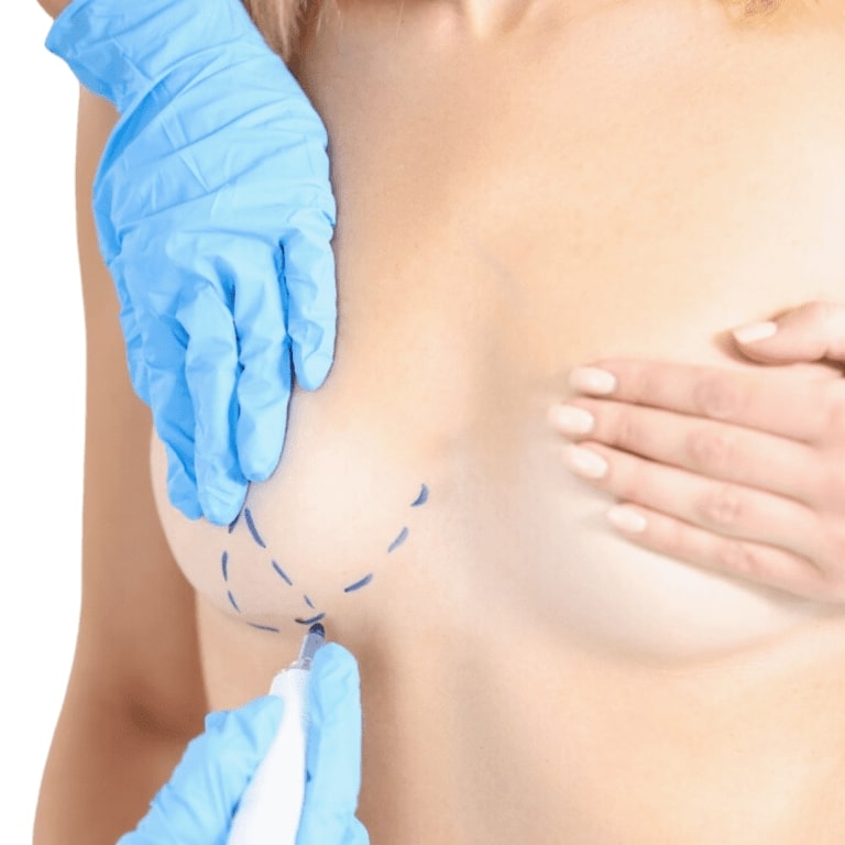 Choosing Areola Reduction Surgery for Symmetry