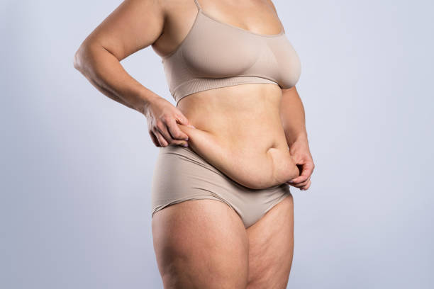 Does Tummy Tuck Surgery Fix Diastasis Recti?