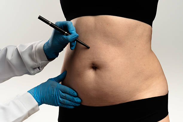 What Makes Liposuction Surgery Popular Worldwide?