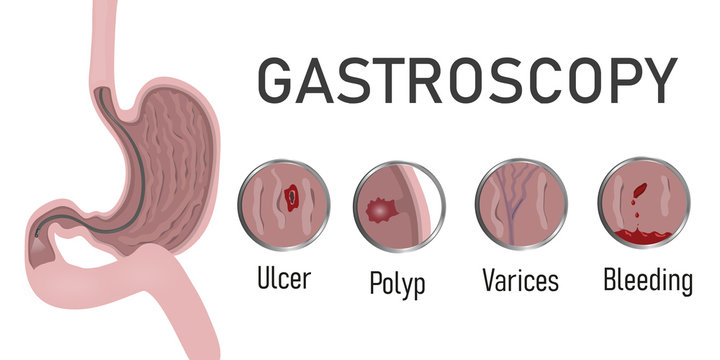 gastroscopy cost singapore