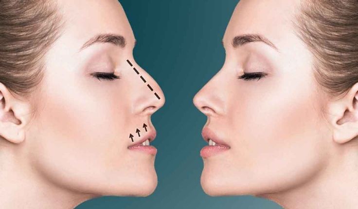 Rhinoplasty in Riyadh