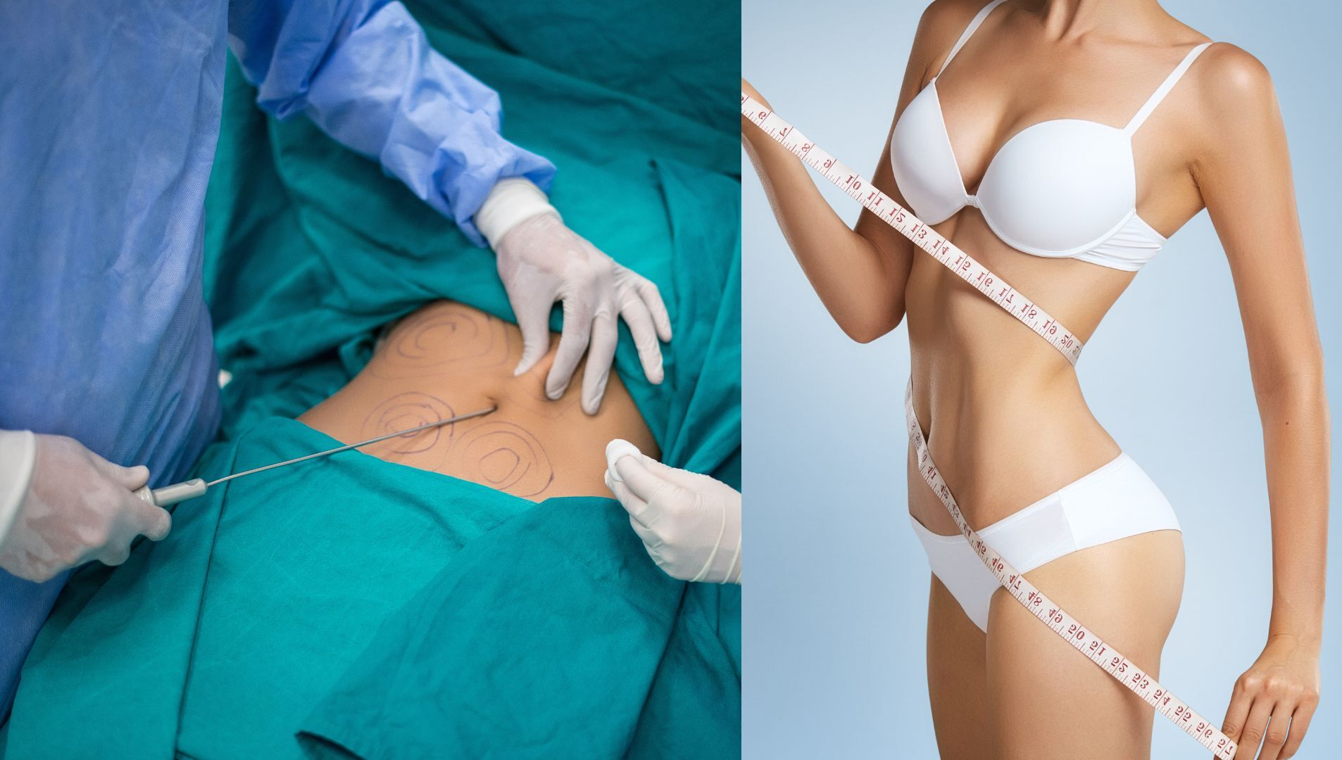 Liposuction Riyadh